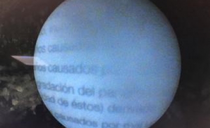 输尿管镜手术操作技巧的体会及R.Wolf输尿管镜的维修案例