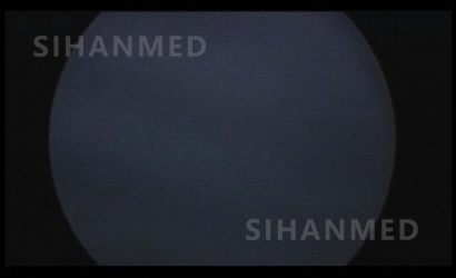 经皮肾镜联合输尿管软镜同期治疗介绍及SOPRO经皮肾镜维修案例